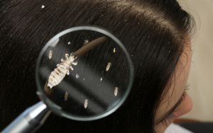 Head Lice